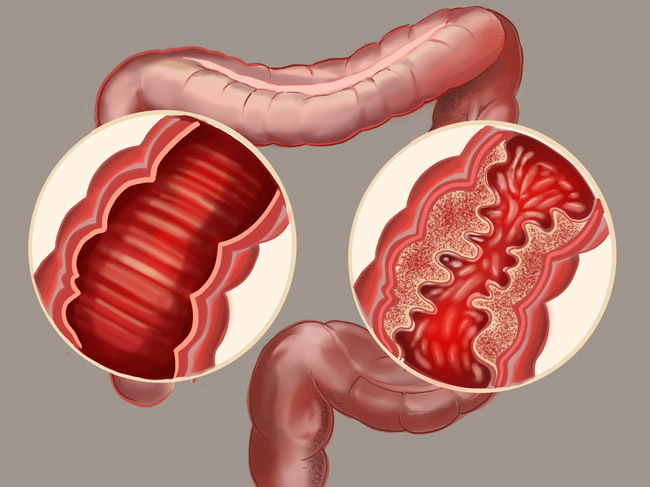 Ver lo invisible: un nuevo microscopio busca respuestas sobre la enfermedad de Crohn